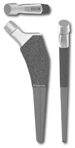 Titanium hip replacement stem (Medacta AMIStem) used by Dr Chien-Wen Liew, Adelaide