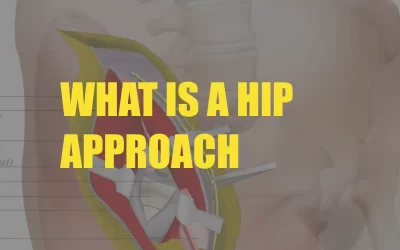 What is a Hip Approach