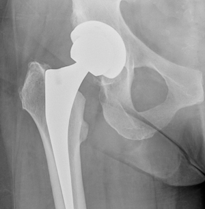 Total Hip Replacement performed via the Direct Anterior Approach