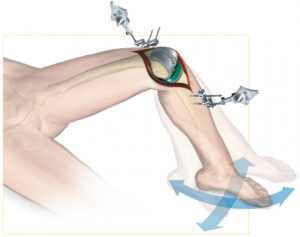 Computer Navigation for Total Knee Replacement Adelaide