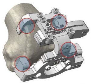 Patient Specific Technology for Total Knee Replacement Adelaide