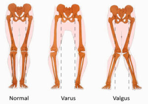 Varus and Valgus alignment of the knee