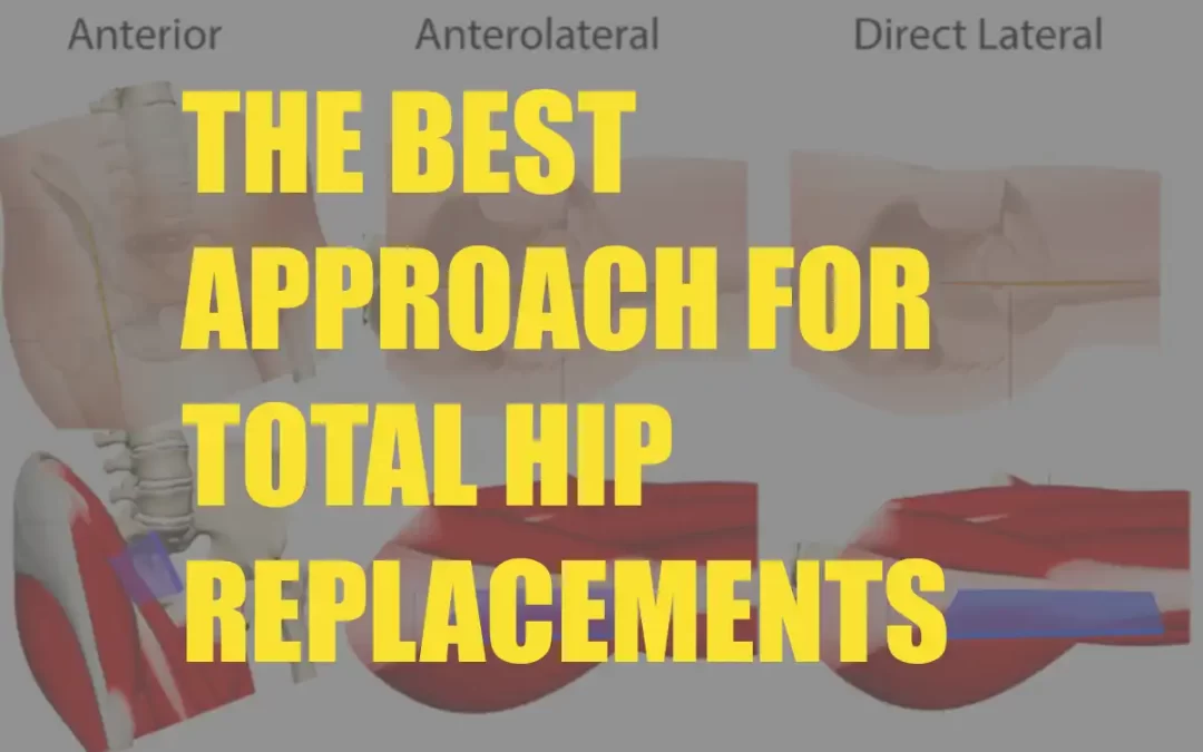 What is the best approach for Total Hip Replacements?