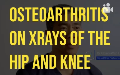 Osteoarthritis on Hip and Knee Xrays