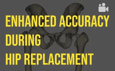 Enhanced accuracy during hip replacement surgery